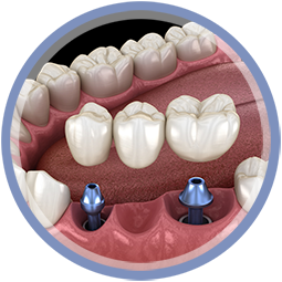 Chirurgie - Implantat - Implantatbrücke