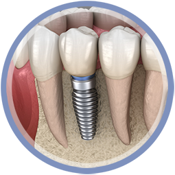 Chirurgie - Implantat - Einzelimplantat